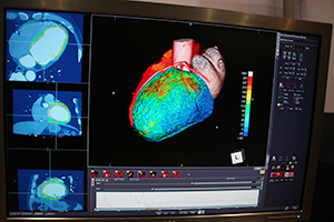 心筋パーフュージョンのデータと冠動脈の情報をマルチデータフュージョンで表示して責任血管などを把握