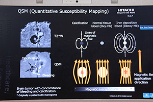 T2*強調画像で出血と石灰化の鑑別が可能になる「QSM（Quantitative Susceptibility Mapping）」（W.I.P.）