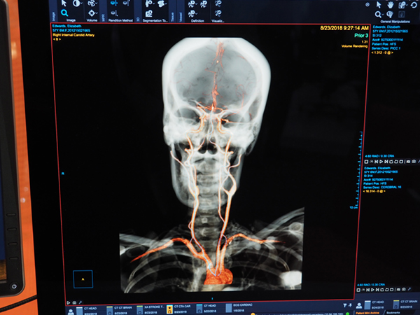 Head & Neck Vessel Analysis Protocol（W.I.P.）。頭頸部画像からバックグラウンドでAIが血管を認識して瞬時に表示する。