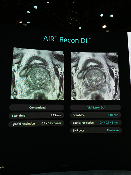 MRIに搭載される予定の“AIR Recon DL”（開発中，技術参考展示）