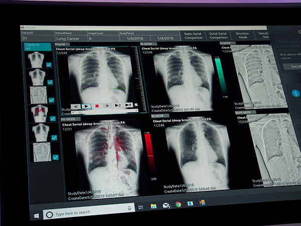 X線動画解析ワークステーション「KINOSIS」。横隔膜の動きを自動認識し，グラフ表示することが可能（左上。グラフは別画面で表示）。さらに，呼吸や血管の拍動に伴う肺組織の動きを捉え，表現できる。
