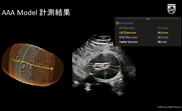腹部大動脈瘤を立体的に自動計測する“AAA Model”