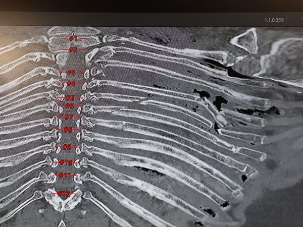 Open Ribでは胸郭の展開表示・肋骨ラベリングにより迅速な治療方針決定を支援