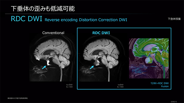 RDC DWIで下垂体の歪みを抑制することで，他シーケンスとのフュージョンも可能に。