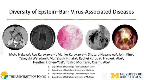 MSEE-55  Diversity of Epstein-Barr Virus-associated Diseases 仲谷　元 氏（東京大学）ほか