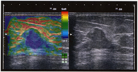 Real-time Tissue Elastographyの画像例
