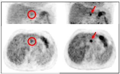 従来のPET/CT（左）とDiscovery PET/CT 600（右）の画像