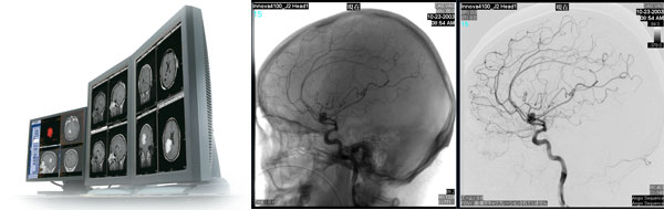 最左：Centricity PACS 3.2のワークステーション　右2枚：Centricity PACS3.2で再構成した頭部血管のDSA画像