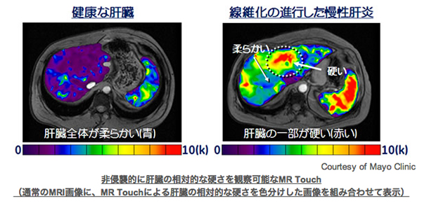 非侵襲的に肝臓の相対的な硬さを観察可能なMR Touch（通常のMRI画像に、MR Touchによる肝臓の相対的な硬さを色分けした画像を組み合わせて表示）