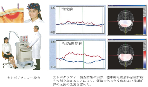 光トポグラフィー検査