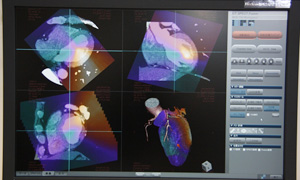 VAvP[VuCT-SPECT 3D Fusionv