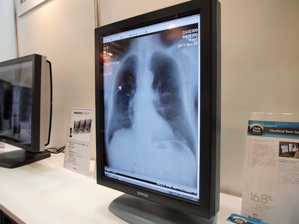 胸部の軟組織画像を作成するClearRead Bone Suppression