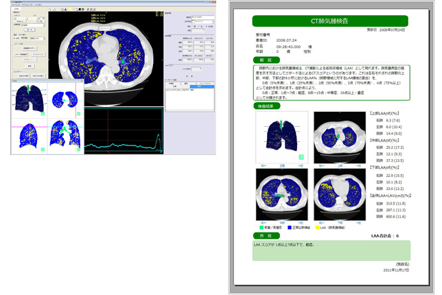 肺気腫計測ソフト『LungVision2』(ラングビジョン2)