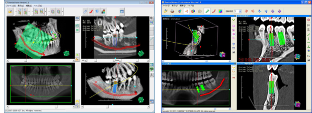 歯科用DICOMビューワ 『DentistVision』 『DentistVision Professional』 (デンティスト・ビジョン/プロ)
