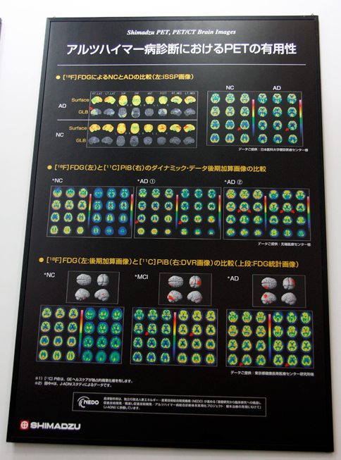 アルツハイマー病診断におけるPETの有用性