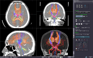 MRトラクトグラフィー