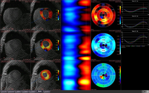 MRストレイン解析