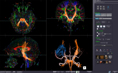 MRトラクトグラフィ