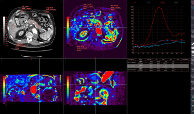 CTボリューム血流解析