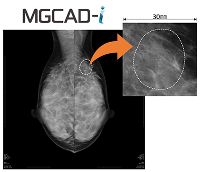 マンモグラフィー診断支援ソフトウェアライセンス MGCAD-i
