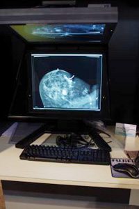 QloiꂽSDMiStereo digital Mammographyj