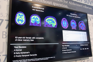 AcnC}[a̒ʉ\tgEGAPET Amyloid SUV Analysis