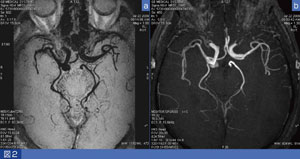 }2@CubeŎB]ᎂblack blood MRATOF MRA@aFCube PD摜@bF3D TOF
