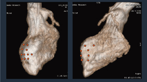 }2@LAD MIiSwinejModel. Planned Injection Points Volume Rendered Model