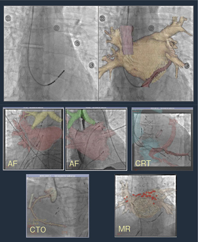 }4@Fusion ImagingFCT and Fluoro for Cardiac Navigation and Positioning