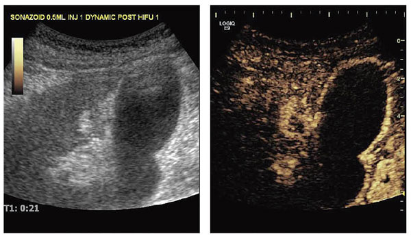 図3　症例2：胆嚢近傍に発生した小さな肝がん