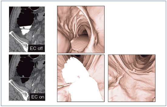図1 fecal tagging, electronic cleansing 法による残渣・残液の除去