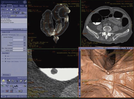図3 Advantage WorkstationのCTC読影画面