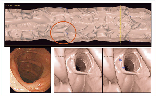 図4 病変の自動検出ソフトウェア“VCAR”