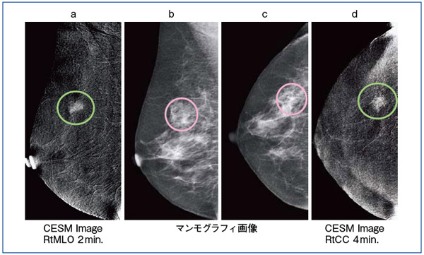 図3 症例2:構築の乱れが認められた症例(浸潤性乳管癌)