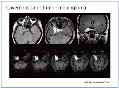 }12@Ǘ7Fcavernous sinus tumor