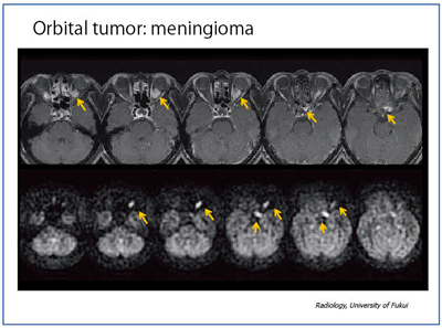 }13@Ǘ8Forbital tumor