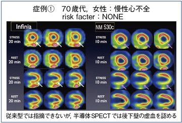 }2@AK[^SPECTƔSPECT̉掿̔r