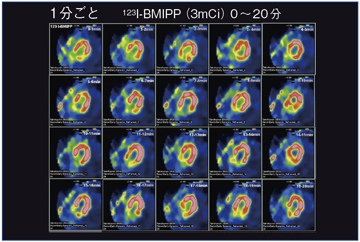 }4@123I-BMIPP1Ƃ̃_Ci~bNW̉摜