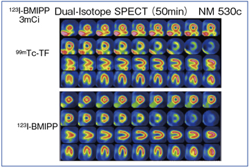 }5@j퓯Wœꂽ99mTc-TFij123I-BMIPPij̉摜