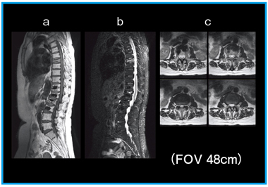 図2 経皮的椎体形成術後の圧迫骨折