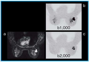 図4 乳房の浸潤性腺管癌