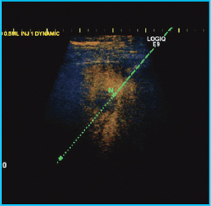 }3@UltraProepIn-Plane Needle Trackingɂ̐