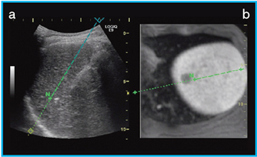 }4@Off-Plane Needle Tracking̃Cu摜iajƑeMRIƂFusionɂNeedle In Plane\ibj