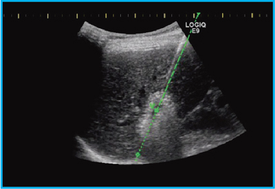 }6@Virtu TRAXɂRFA j惂j^iCool-tip Needlej