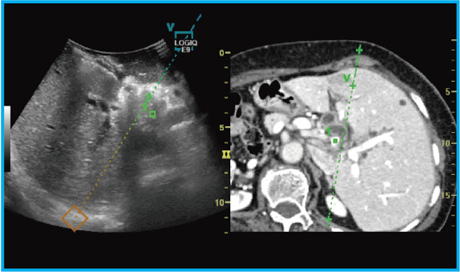 }6@Needle in Planẻp