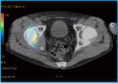 }2@Ǘ1FSPECT/CTt[W摜