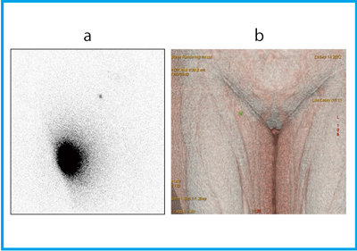 }6@Ǘ3FEڈFpLymphoscintigraphyiajSPECT/CTt[W3D摜ibj