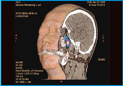 図8 症例4:両側眼窩下神経病変のCT 3D VR画像とSPECTフュージョン画像