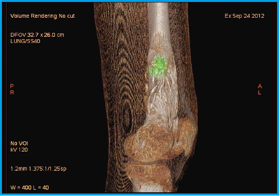 図9 症例5:骨肉腫化学療法後のCT 3D VR画像とSPECTのフュージョン画像