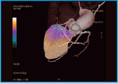 図12 症例8:CABG後胸痛のSPECT/CT-造影CTフュージョン3D画像
